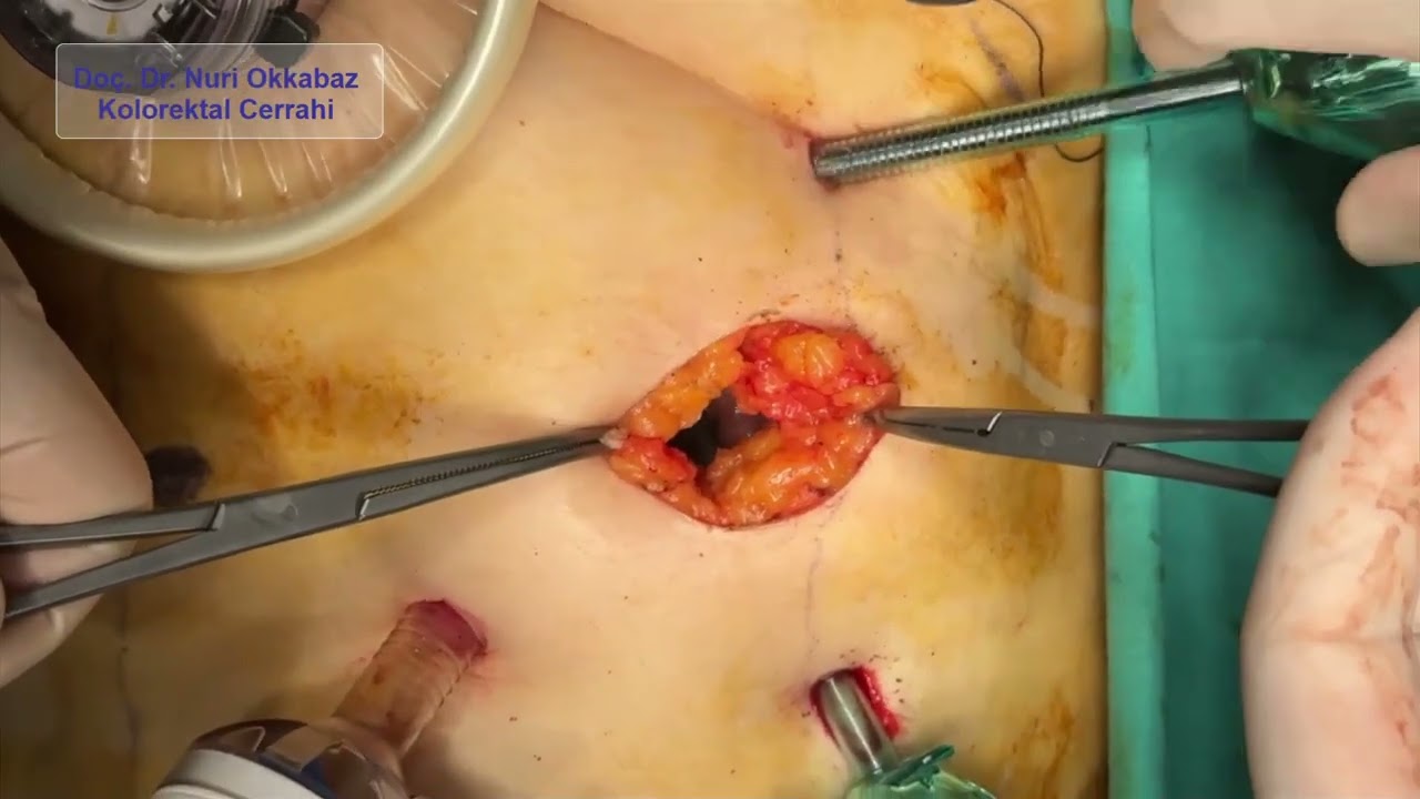 Creation of a Temporary Ileostomy (Stoma)