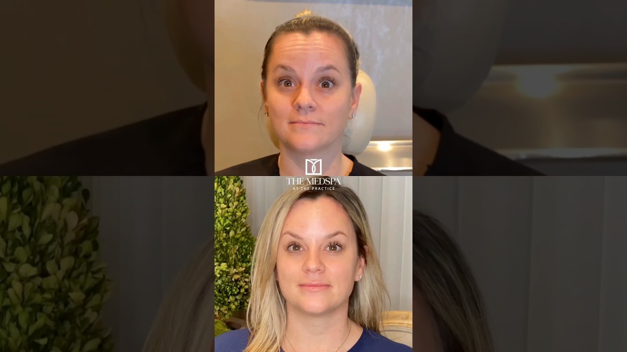 Botox + Lip Filler Before & After