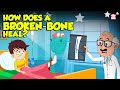 How Bone Fractures Heal How Does A Broken Bone Heal Process Of Bone Healing Dr Binocs Show