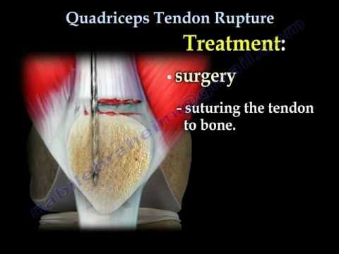 Rupture du tendon du quadriceps - Tout ce que vous devez savoir