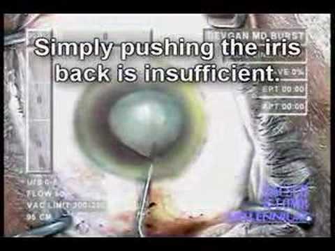 Iris Prolapse During Cataract Surgery - Proceeding