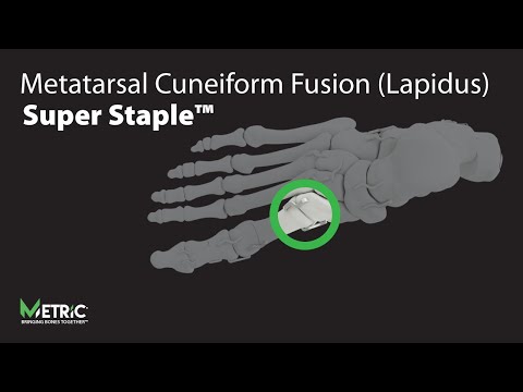 Metatarsal Cuneiform Fusion (Lapidus) - Super Staple™