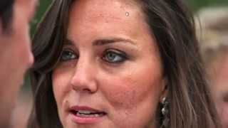 Royal Facial Signs -- Adrenal Fatigue -- Acidosis -- Anemia -- Heavy Metals