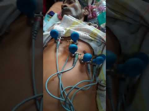 ECG LEAD PLACEMENT-ECG ELECTRODES