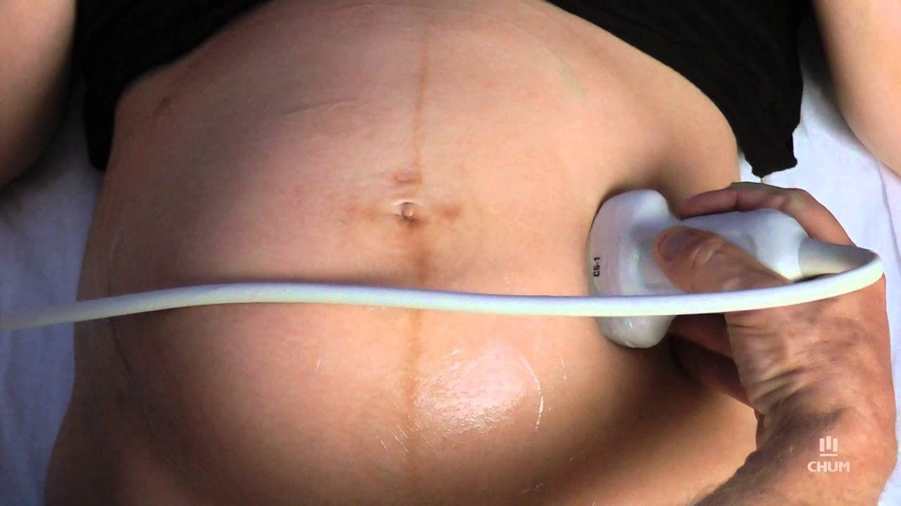 Watch video LA VERSION : modification de la position du bébé LA VERSION : modification de la position du bébé