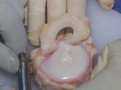 Lateral Meniscus Transplant Surgical Technique