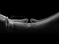 How are Macular Holes formed & Repaired?