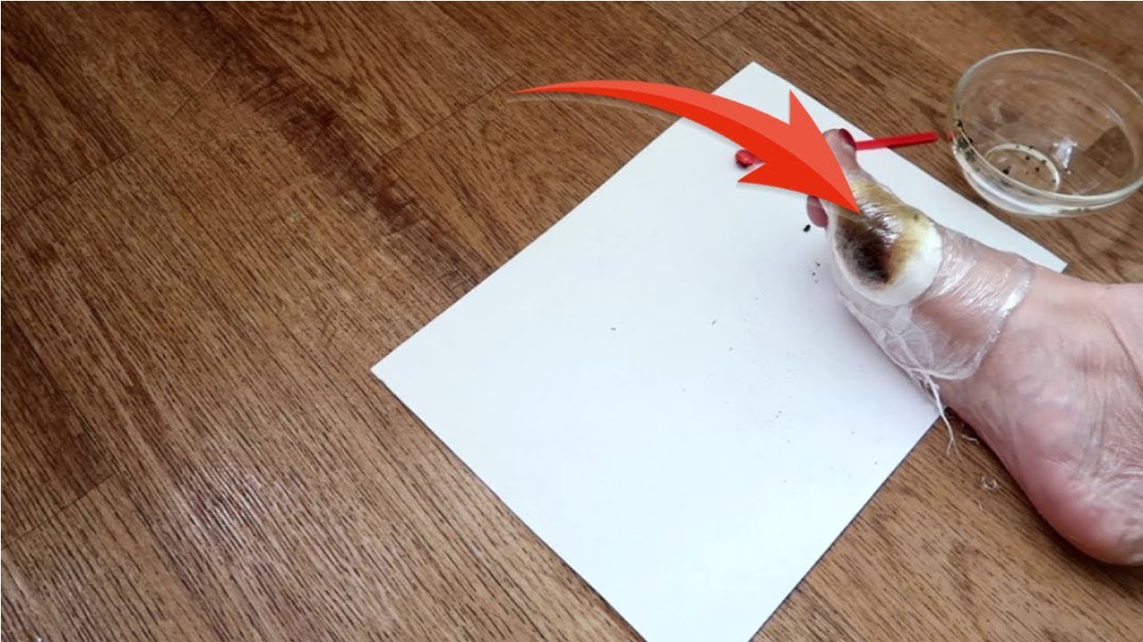 КОСТОЧКА на ноге БОЛЬШЕ не будет БЕСПОКОИТЬ