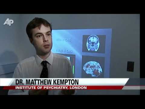 Doctors: Depression Shrinks Parts of the Brain