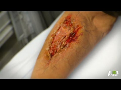 Woman's Arm Literally Eaten Alive by Flesh-Eating Bacteria