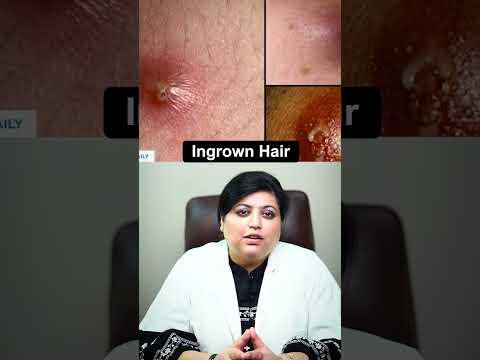 Don't remove your ingrown hair in a wrong way | Ingrown Hair | #ingrownhair #shorts #youtubeshorts