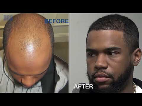 Hair Transplant Results - African American - 9 Months...
