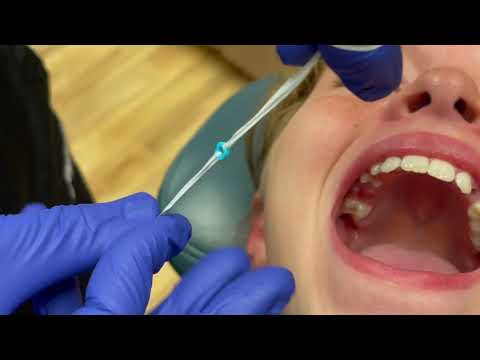 How To Put Spacers In At Home | Jones Family Orthodontics | Monroe, Washington