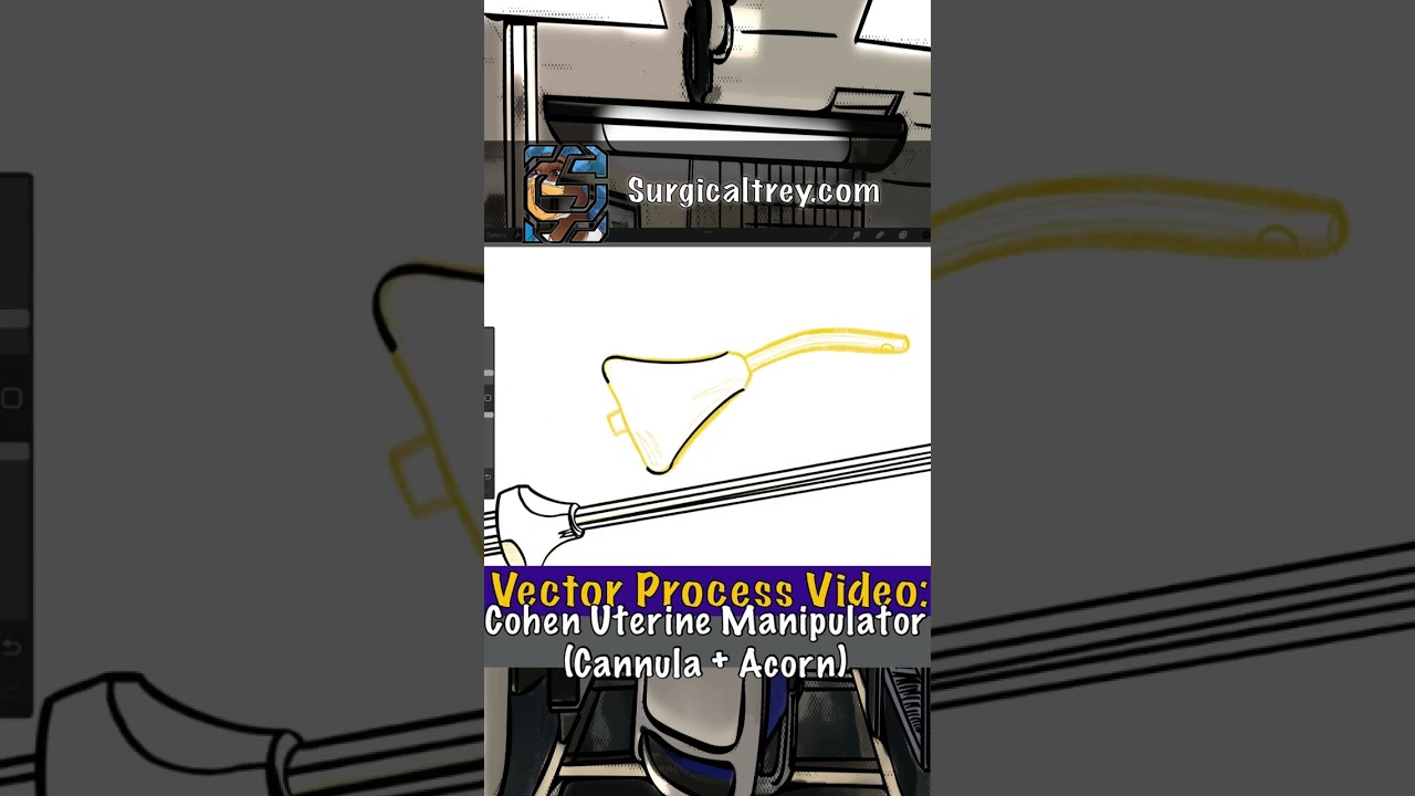 Surgicaltrey Art Series: Cohen Uterine Manipulator | Vector Drawing Behind the Scenes