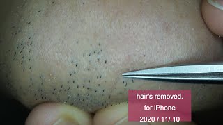 Extractions Unwanted Hair l Tweezers Beard l 2020/11/5