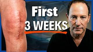 Knee Replacement Recovery: The First 3 Weeks That Determine Your Outcome