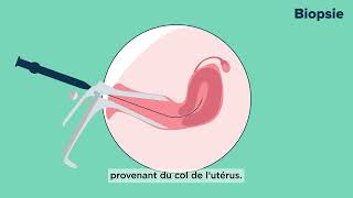 Cancer du col de l’utérus : Le connaître pour mieux le prévenir