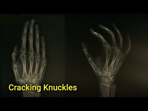 This is what happens when you crack your knuckles