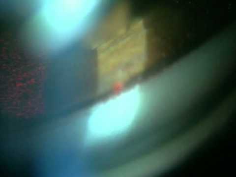 Su citazione di lentiggini Crema di klirvin da risposte di pigmentazione