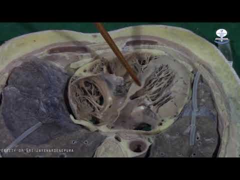 Cadaveric Demonstration Cross section T8 level by Dr Sajith Edirisinghe