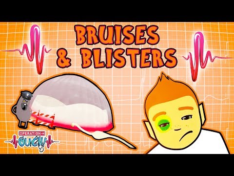 Operation Ouch - Bruises & Blisters | Human Skin