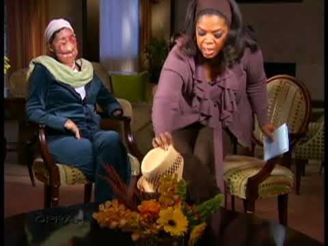 Chimp Attack Survivor Shows Her Face