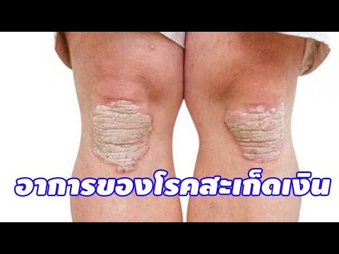 รูปภาพ neurodermatitis ในมือ โรคสะเก็ดเงินและอาการคัน