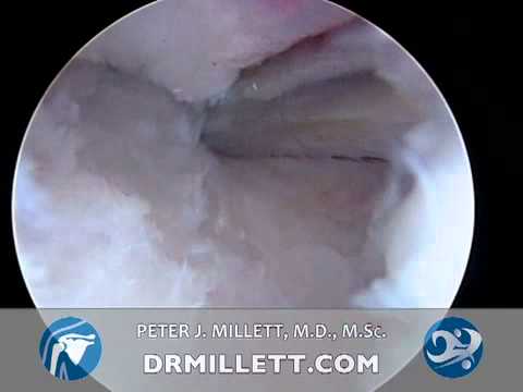 Procedimiento CAM | Cirugía de osteoartritis de hombro | Vail y Greater Denver CO