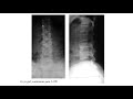 Prof Robert Dunn Back Pain Sciatica