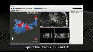 ADAS 3D for the Left Atrium