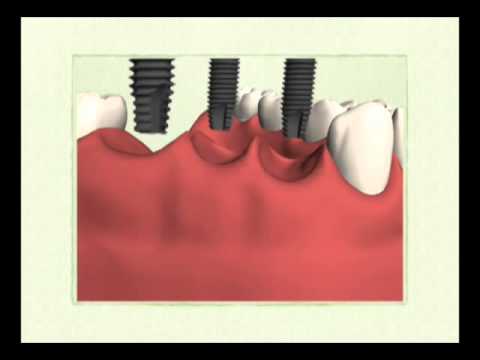 Praxis Dr. Erhard - Mehrfach Implantatbrücke
