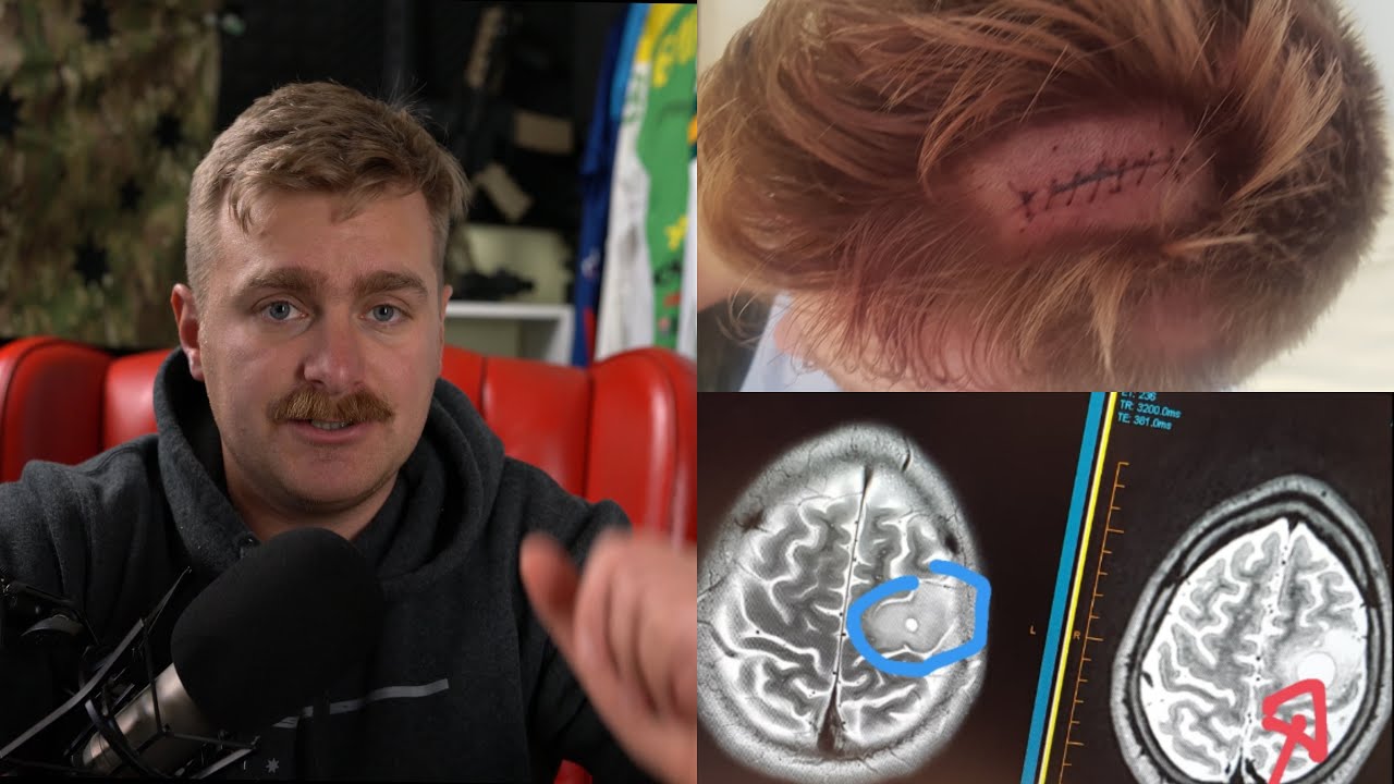 How I discovered I had a deadly Brain Tumor: Signs, Symptoms, Surgery, Chemo, Diagnosis, Prognosis