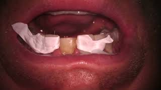 Re-bonding Veneer