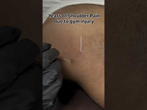 🔥 Gym Injury Ke Baad Years Se Shoulder Pain? 😣 #shorts #foryou