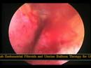 Trans-cervical resection of endometrium TCRE operative video