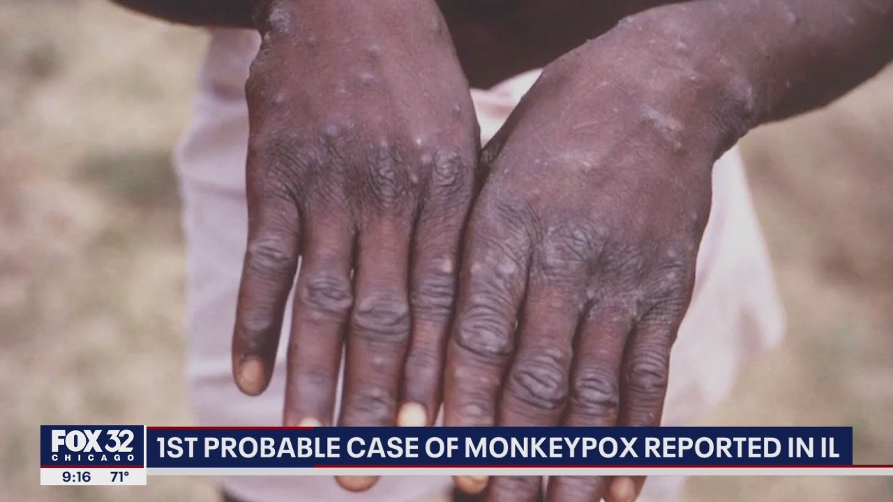 First probable case of monkeypox detected in Illinois