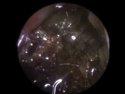 834 - Severe Ear Wax Removal & Keratosis Obturans