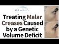 How Malar Creases Caused by a Genetic Volume Deficit can be Treated