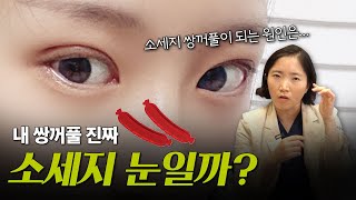 소세지 쌍꺼풀 재수술 어떻게 가능할까?