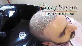 How to do the nine hair wash after hair transplant / Removing Scabs