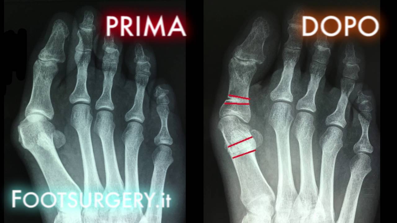 Alluce Valgo senza fissazione Attenti alle conseguenze | Alluce valgo prima e dopo intervento
