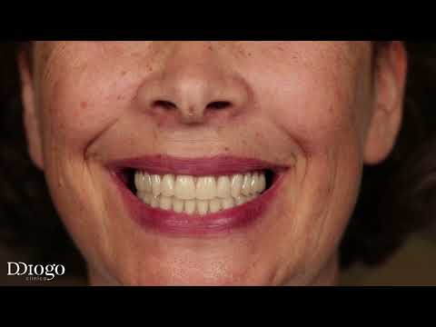 Colocação de prótese dentária fixa