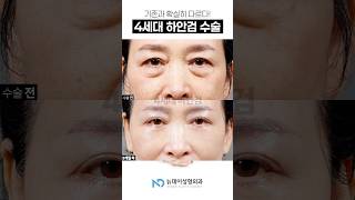하안검 성형 성형 시술
