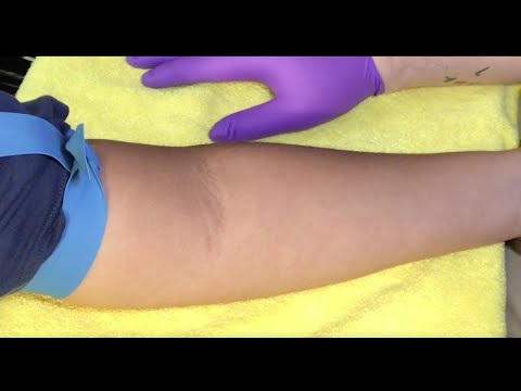 Tips For Locating Difficult Veins