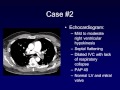 Massive Submassive Pulmonary Embolism