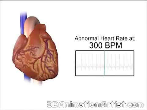 Heart Beatin at 300 BPM