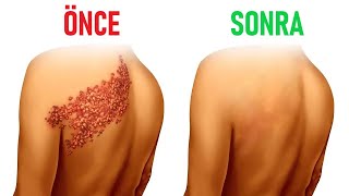 Zonadan Kalıcı Olarak Nasıl Kurtulur? | Dr.Berg Türkçe