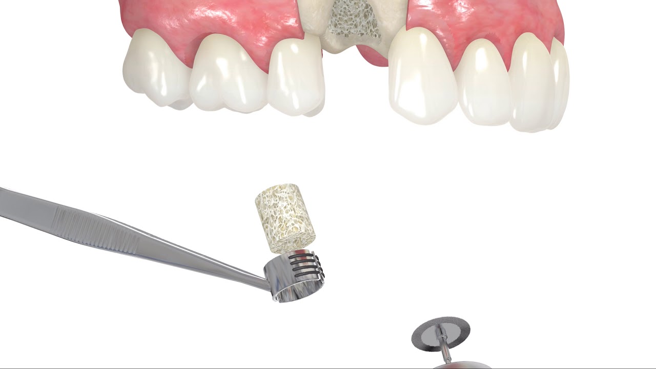 Bone Ring Ridge Augmentation
