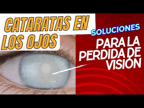 Cataratas en los Ojos Soluciones Efectivas para la perdida vision. - Dra Ximena Mira - Oftalmologo