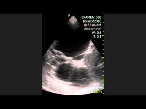 Polycystic Syndrome Of The Kidney